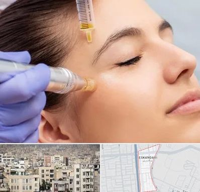 میکرونیدلینگ در اسکندری