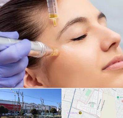 میکرونیدلینگ در فاز دو اندیشه