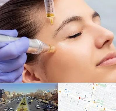 میکرونیدلینگ در بلوار معلم مشهد