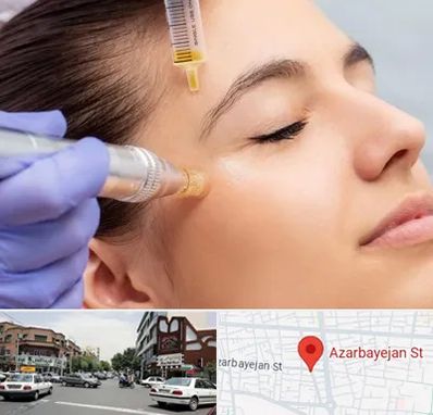 میکرونیدلینگ در خیابان آذربایجان