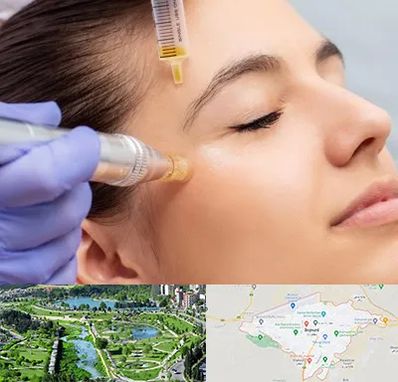 میکرونیدلینگ در بجنورد