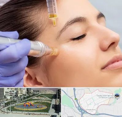 میکرونیدلینگ در مرزداران تبریز