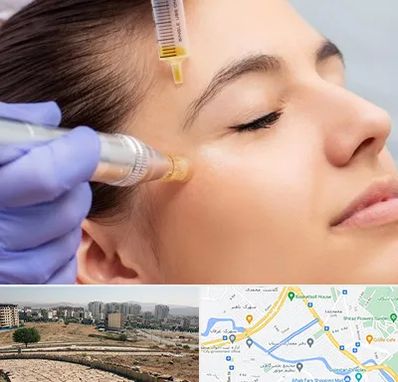 میکرونیدلینگ در کوی وحدت شیراز