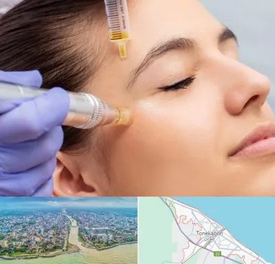 میکرونیدلینگ در تنکابن