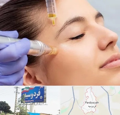 میکرونیدلینگ در فردوسیه شهریار