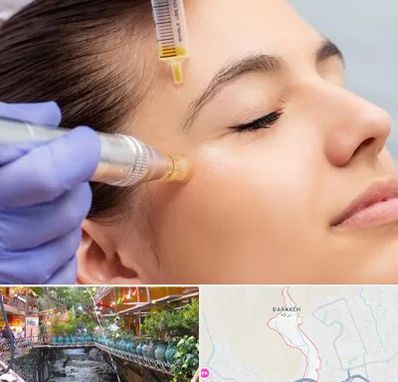 میکرونیدلینگ در درکه