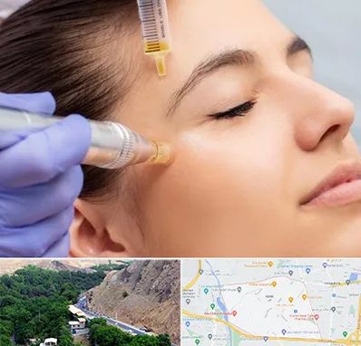 میکرونیدلینگ در کن