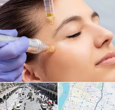 میکرونیدلینگ در نادری اهواز