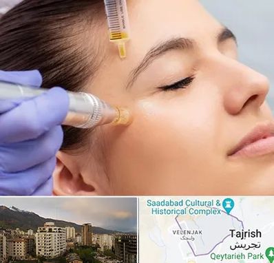 میکرونیدلینگ در زعفرانیه