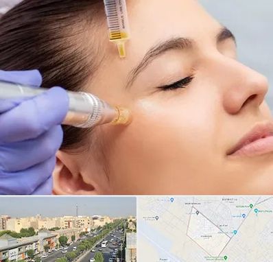 میکرونیدلینگ در کیانمهر کرج