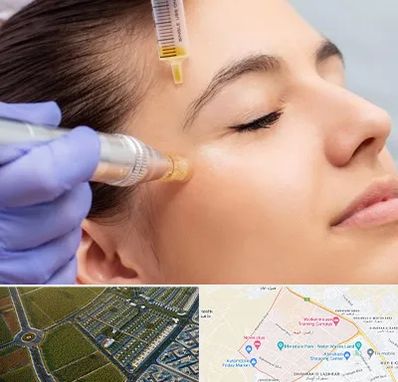 میکرونیدلینگ در الهیه مشهد