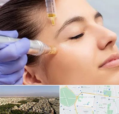 میکرونیدلینگ در نازی آباد