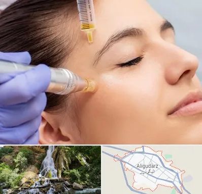 میکرونیدلینگ در الیگودرز