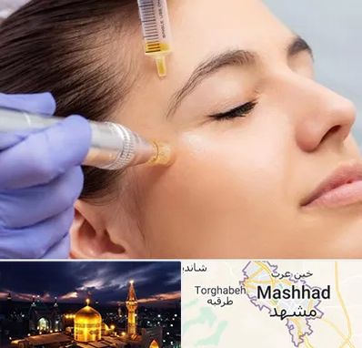میکرونیدلینگ در مشهد
