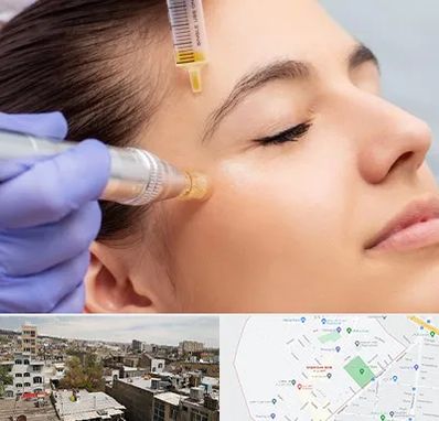 میکرونیدلینگ در شمیران نو