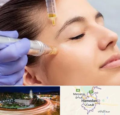 میکرونیدلینگ در همدان