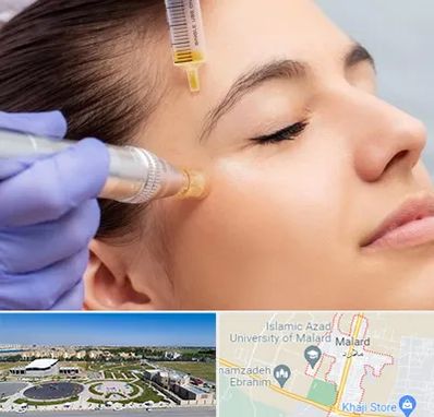 میکرونیدلینگ در ملارد