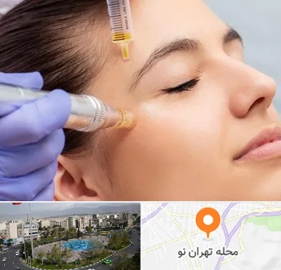میکرونیدلینگ در تهران نو