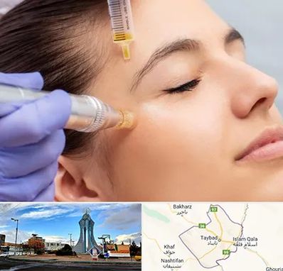 میکرونیدلینگ در تایباد