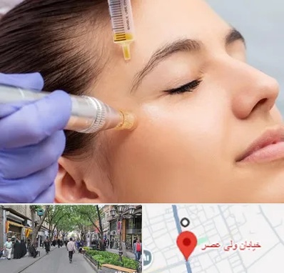 میکرونیدلینگ در ولیعصر شهریار