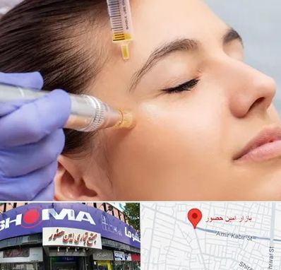 میکرونیدلینگ در امین حضور