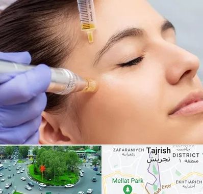 میکرونیدلینگ در تجریش