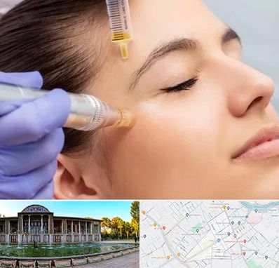 میکرونیدلینگ در عفیف آباد شیراز
