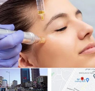 میکرونیدلینگ در چهارراه طالقانی کرج