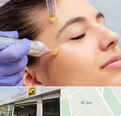 میکرونیدلینگ در عبدل آباد