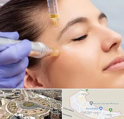 میکرونیدلینگ در پرند