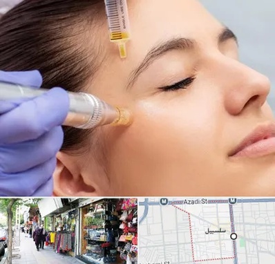 میکرونیدلینگ در سلسبیل
