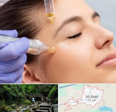 میکرونیدلینگ در علی‌ آباد کتول