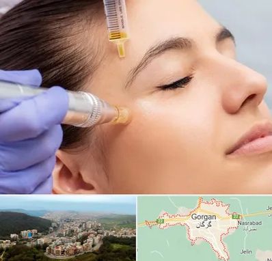 میکرونیدلینگ در گرگان