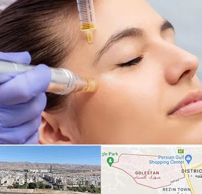 میکرونیدلینگ در شهرک گلستان شیراز