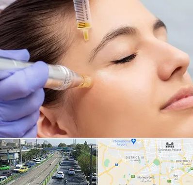 میکرونیدلینگ در جنوب تهران