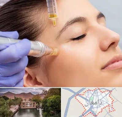 میکرونیدلینگ در دامغان