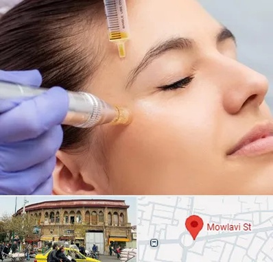 میکرونیدلینگ در مولوی