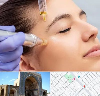 میکرونیدلینگ در مصلی مشهد