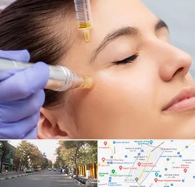 میکرونیدلینگ در شریعتی