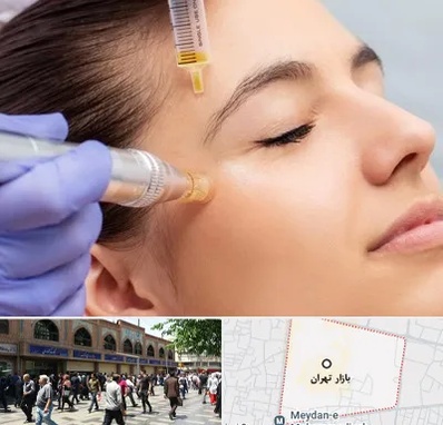 میکرونیدلینگ در بازار تهران