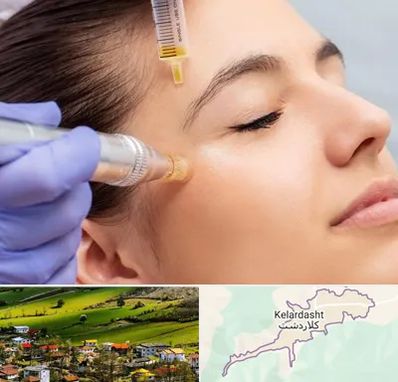 میکرونیدلینگ در کلاردشت