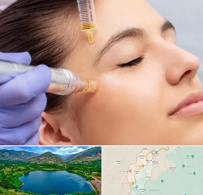 میکرونیدلینگ در رودبار