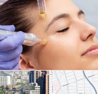 میکرونیدلینگ در خیابان بهشتی