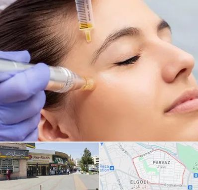 میکرونیدلینگ در پرواز تبریز