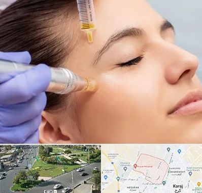 میکرونیدلینگ در شاهین ویلا کرج