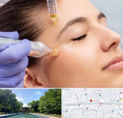 میکرونیدلینگ در هشت بهشت اصفهان