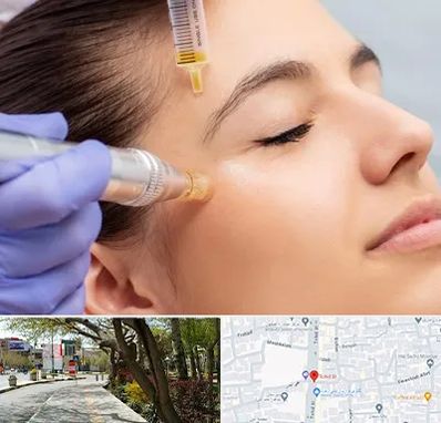 میکرونیدلینگ در خیابان توحید اصفهان