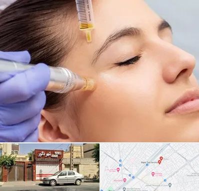 میکرونیدلینگ در باجک قم