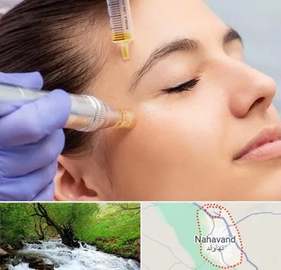 میکرونیدلینگ در نهاوند