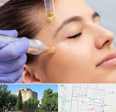 میکرونیدلینگ در مرداویج اصفهان